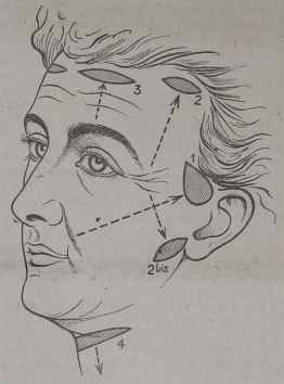 La Chirurgie Esthétique des Rides du Visage.